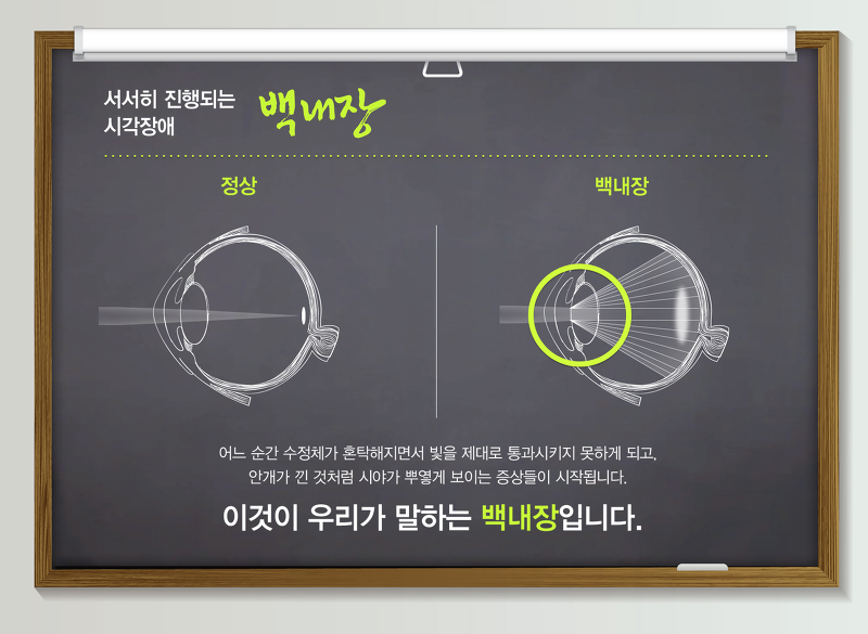 Healthier Life of ENZAIM :: 노안과 백내장 해결을 위한 AT ...