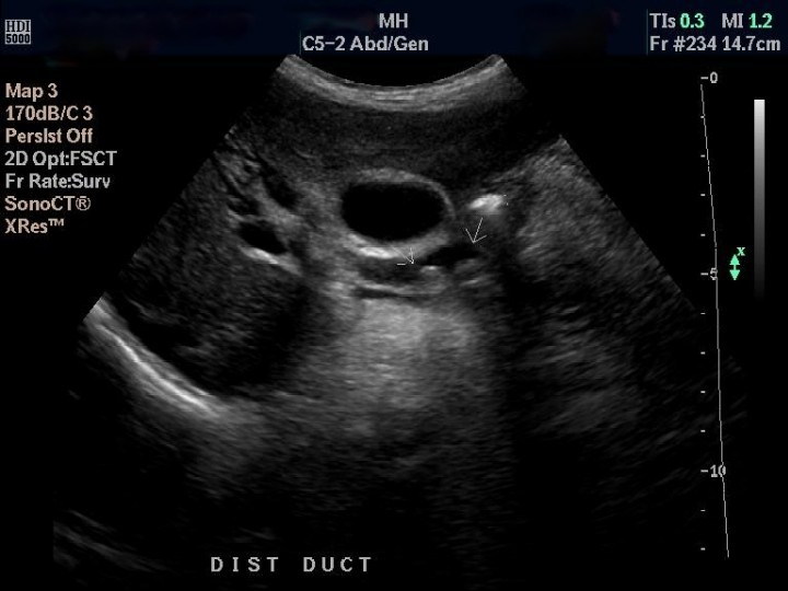 common bile duct cat. 2011 common bile duct (arrow). common bile duct ultrasound.